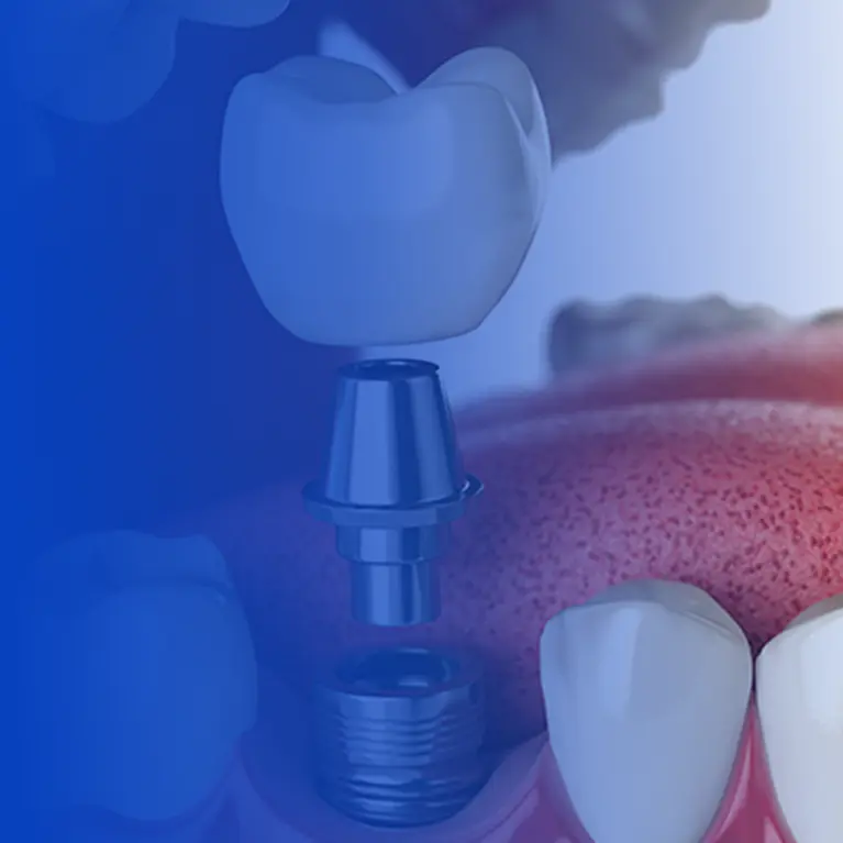 Basic Implantology